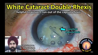 CataractCoach 1040: dense white cataract double rhexis technique