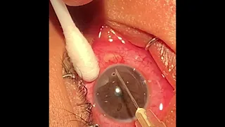 How to remove corneal foreign body from the eye