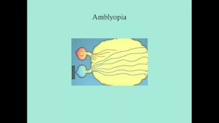 Amblyopia - CRASH! Medical Review Series