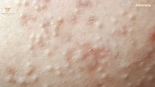 Hidden acne Extraction on young girl at hien van spa-432-Ngoc Thuy