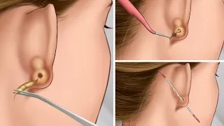 ASMR Remove ear piercing pus | Squeeze ear acne