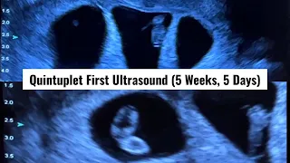 Our First Ultrasound at 5 Weeks & 5 Days! It's Five?? ***Finding Out We Were Having Quintuplets