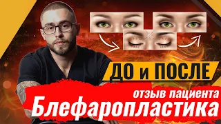 Блефаропластика отзыв пациента: чего боятся перед операцией? Результат до после