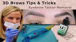 Eyebrow Tattoo Removal using Saline solution