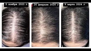 С двумя мощными ингредиентами волосы  растут в разы быстрее. Эффективность равна Миноксидилу 2%
