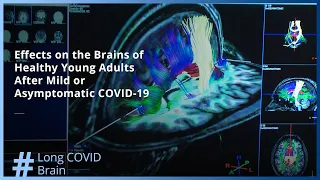 New Research: Effects on the Brains of Healthy Young Adults After Mild or Asymptomatic COVID-19