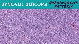 Synovial sarcoma (monophasic) with classic "herringbone" pattern (soft tissue pathology)