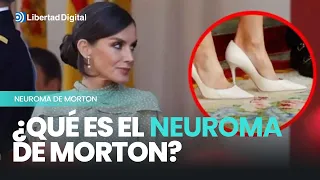 ¿Qué es el neuroma de Morton, la dolencia que sufre la reina Letizia en el pie?