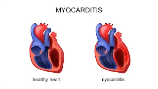 What parents need to know about vaccine-related myocarditis