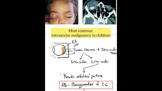 MCQ 1: Orbital Cellulitis and its Mimickers #UKMLA #NEETPG