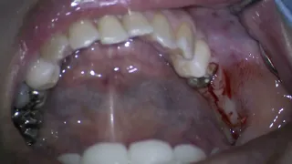 Straumann TLX RT ＆TL WN implant ーPLacement in site 46, 47  Part1