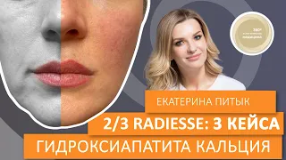 ⅔ Radiesse: 3 кейса по гідроксиапатиту кальцію в одній практиці