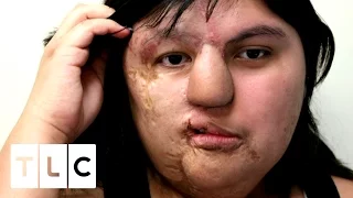 Birthmark Grows and Destroys Girl's Face | Body Bizarre