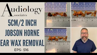 5CM/2INCH JOBSON HORNE EAR WAX REMOVAL - EP516