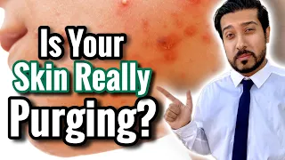 Purging vs Breakout vs Irritation | What Skin Purging Looks Like