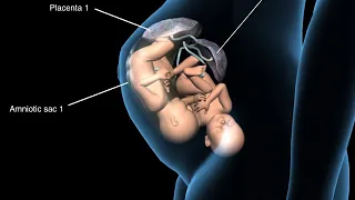 Types of Twins Pregnancy - Anatomical 3D Visualization