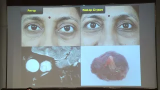 AIOC2022 FP1725 PPP   Ocular Pathology topic Orbital Cavernous Venous Malformation – A Large Case Se