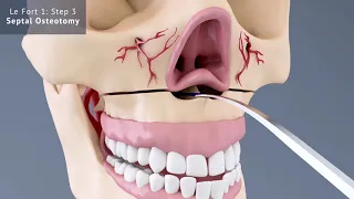 Le Fort 1: Septal Osteotomy