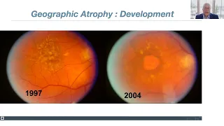 Lecture: Dry Age-Related Macular Degeneration (AMD) Update: New Therapies