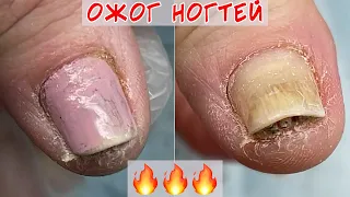 Ожог ногтевой пластины после домашнего маникюра
