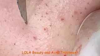 Clean Those White Stuff Out; Acne Removal 103;  (Full Screen) Super Big Pops; Blackheads, Whiteheads