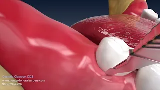 Wisdom teeth removal animation