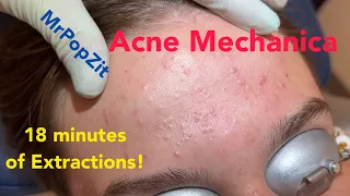 Acne Mechanica. Over 18 minutes of blackhead extractions! Common with football players.