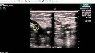 Positive LE DVT Exam - Case Study