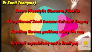 Manual SICS for a complicated Phacolytic Glaucoma