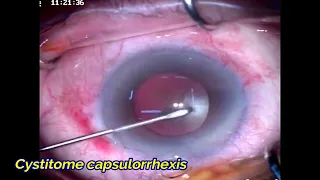 Intracameral adrenaline & OVD to dilate narrow pupil by Dr Khaled Abueleinen1