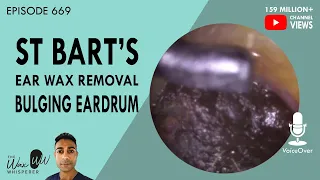 669 - St Bart's Ear Wax Removal Bulging Eardrum