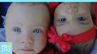 These twins were born with different skin colors | Positive