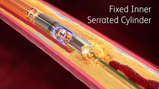 Rotarex™ Rotational Excisional Atherectomy System