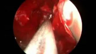 Endoscopic Orbital Decompression.mp4