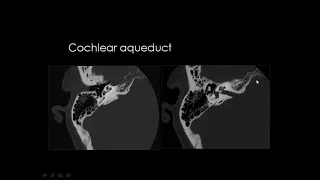 Dr Mamdouh Mahfouz head and neck imaging Petrous bone Anatomy