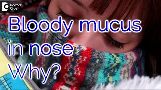 Why do I have bloody mucus in my nose? How it can be managed? - Dr. Satish Babu K