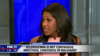 What is Scleroderma? What Are the Symptoms of Scleroderma? A Doctor Explains