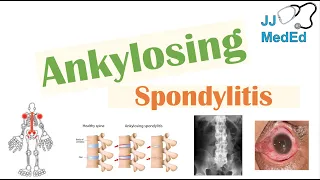 Ankylosing Spondylitis | HLA-B27, Pathophysiology, Signs & Symptoms, Diagnosis, Treatment