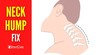 How to Fix Your Neck Hump | STEP-BY-STEP Guide