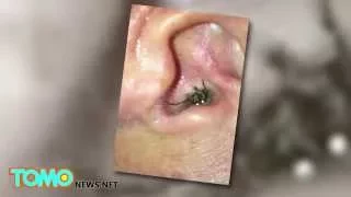 Spider in human ear