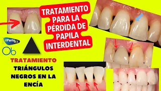 Tratamiento para la pérdida de Papila interdental 🦷 ▲ TRIÁNGULOS NEGROS EN LA ENCÍA