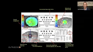 All Inclusive Cataract Care, Considerations, and Complications – Going Far Beyond Phaco and IOL