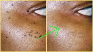 SKIN TAGS | HOW I REMOVE SKIN TAGS OVERNIGHT AT HOME FAST AND EASY