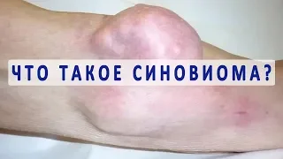 Что такое синовиома и опасна ли она для жизни?