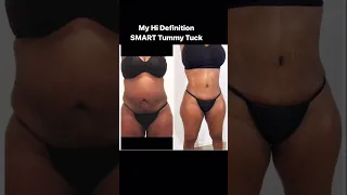 Dr Ravi’s Hi Definition SMART Tummy Tuck 3 months post surgery