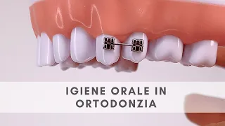 Come pulire i denti quando hai l’apparecchio ortodontico