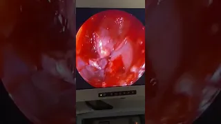 Cirurgia Para Curar Sinusite - Atenção: Imagens de Cirurgia Real - Só Para Adultos E Prof da Saúde