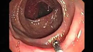 Colonoscopy of Inverted Diverticulum of the Colon