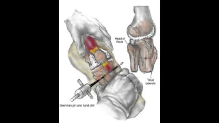 Tibial  Skeletal  Traction Pin  Placement