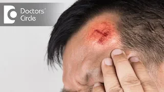 When does a Head Injury require medical attention? - Dr. Suresh H S